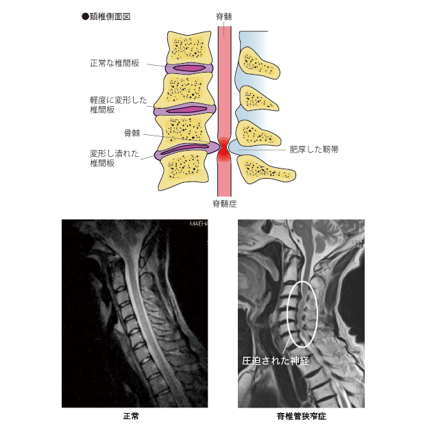 頸部脊椎管狭窄症
