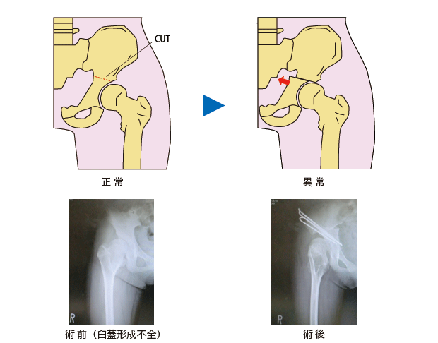 キアリ骨盤骨切術のイラストと術前、術後のレントゲン写真