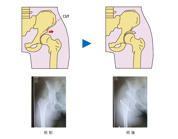 RAO／寛骨臼回転骨切術の術前、術後のレントゲン写真
