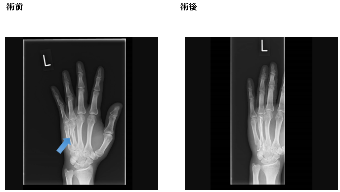 手指骨折の術前、術後のレントゲン写真