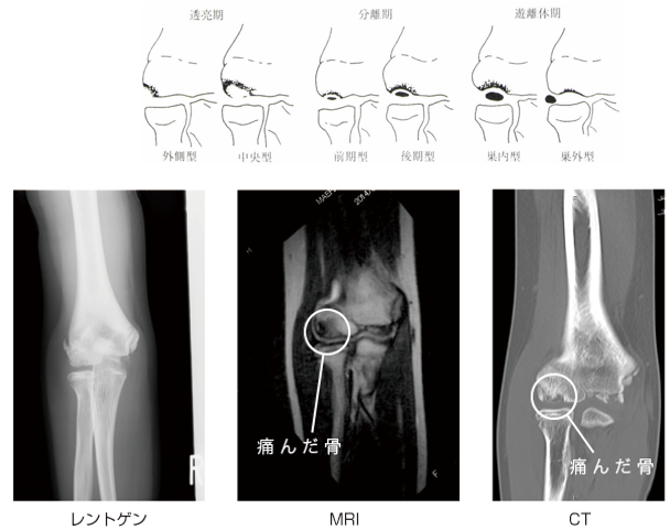 上腕骨小頭離断性骨軟骨炎のイラストとレントゲン、MRI、CT