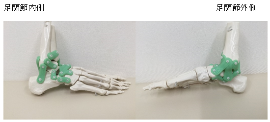 足関節捻挫の模型画像