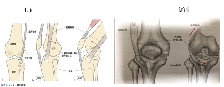 腸脛靭帯炎の正面と側面イラスト図