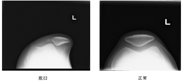 膝蓋骨脱臼のレントゲン写真