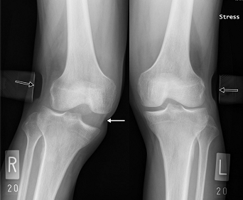 膝のレントゲン画像