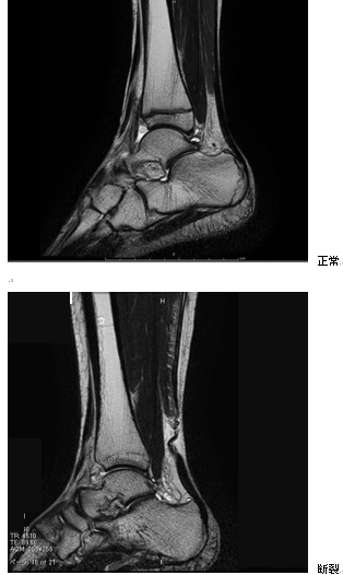 アキレス腱の正常と断裂MRI画像