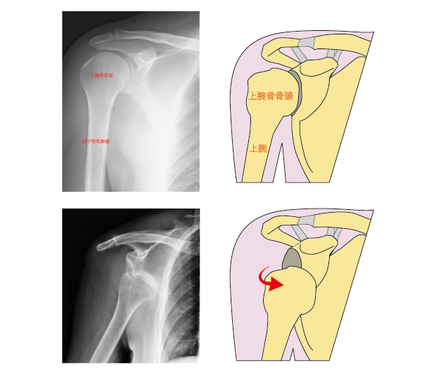 反復性肩関節前方脱臼のレントゲンと図