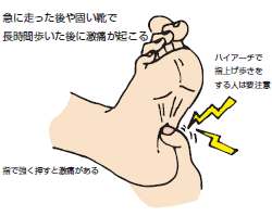 足底腱膜炎のイラスト図