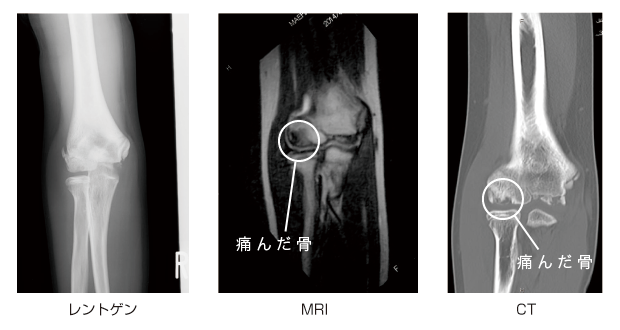 投球障害のレントゲン写真、MRI、CT