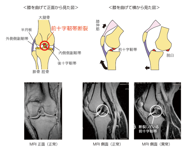 前十字靭帯損傷のイラスト図とMRI画像