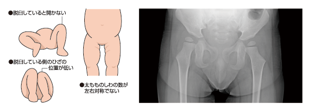 先天性股関節脱臼のイラストとレントゲン写真