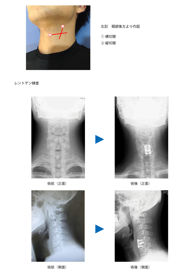 頸椎前方除圧固定術